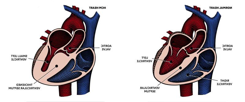 图示正常心脏和HCM